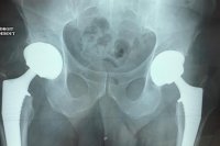Chirurgie de la hanche 